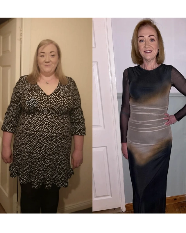 Before and after gastric bypass surgery Before and after gastric bypass surgery