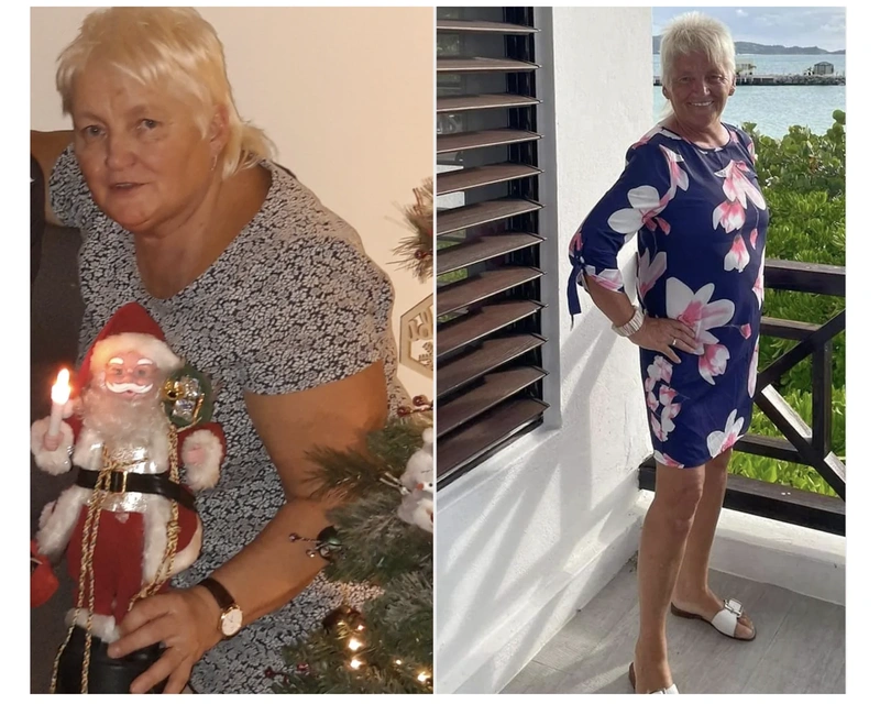 Before and after gastric bypass surgery None