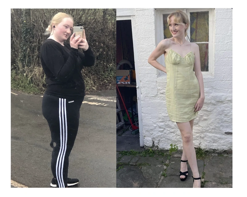 Before and after gastric sleeve surgery Before and after gastric sleeve surgery