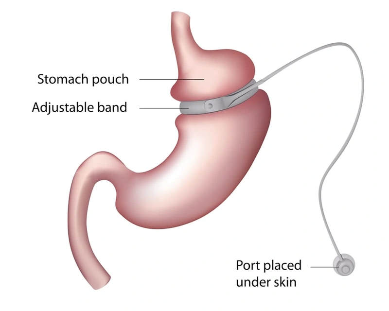 Gastric Band Gastric Band