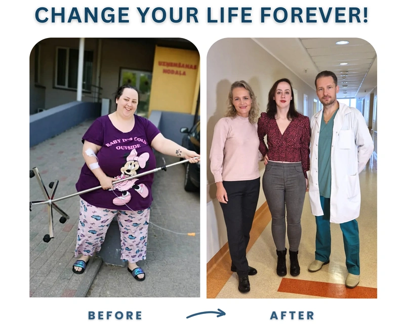 Before and after gastric bypass Before and after gastric bypass