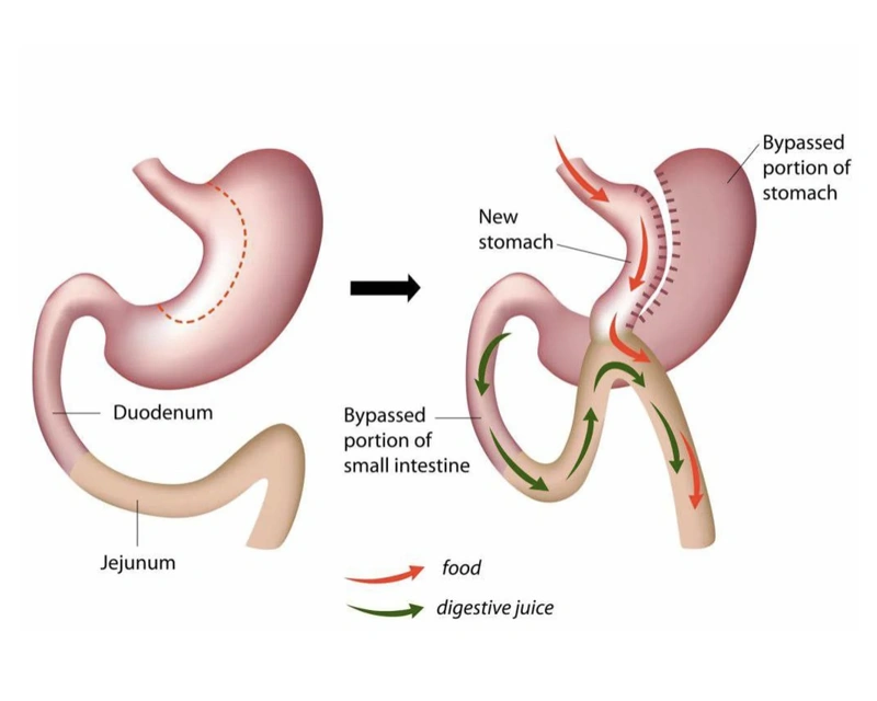 Mini Gastric Bypass Mini Gastric Bypass